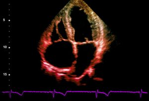 phototake_rm_ultrasound_of_ventricular_hypertrophy